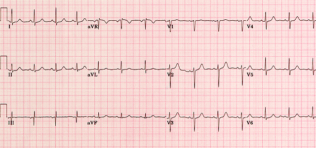 EKG normál